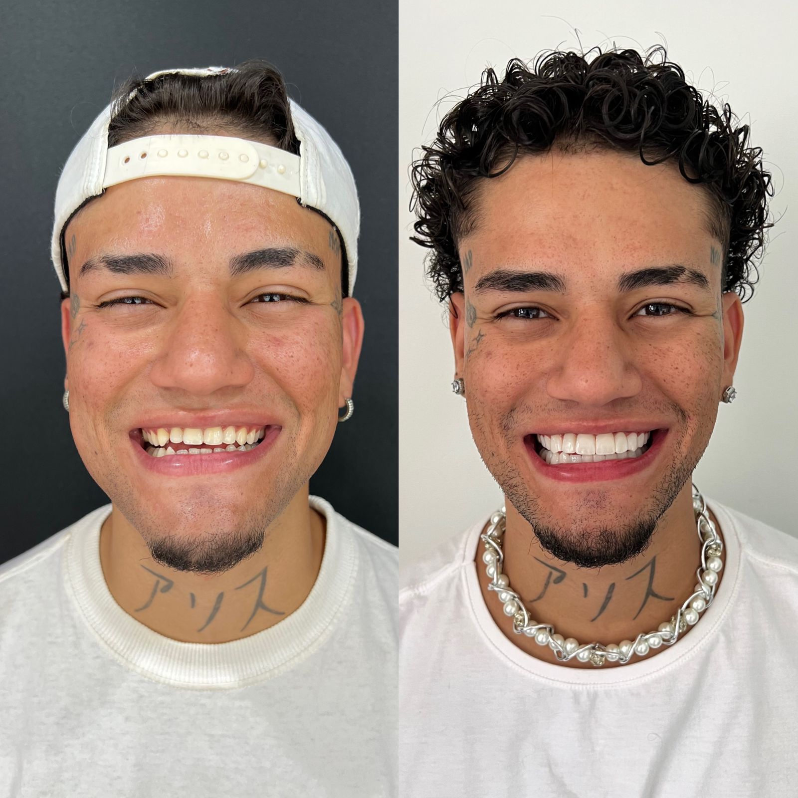 odonto-Antes-e-depois-resinas-1