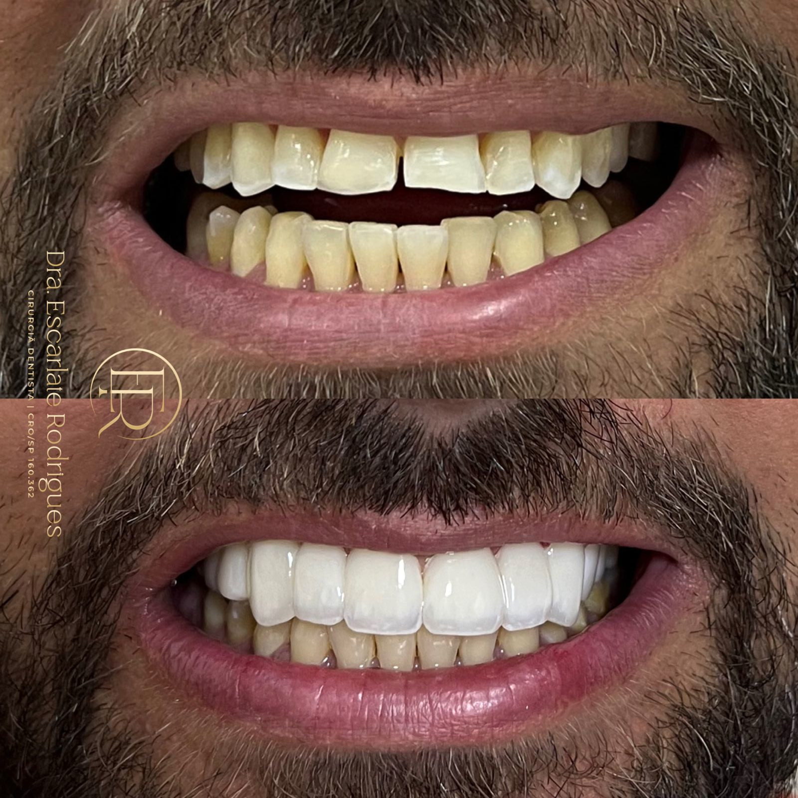 odonto-Antes-e-depois-resinas-2