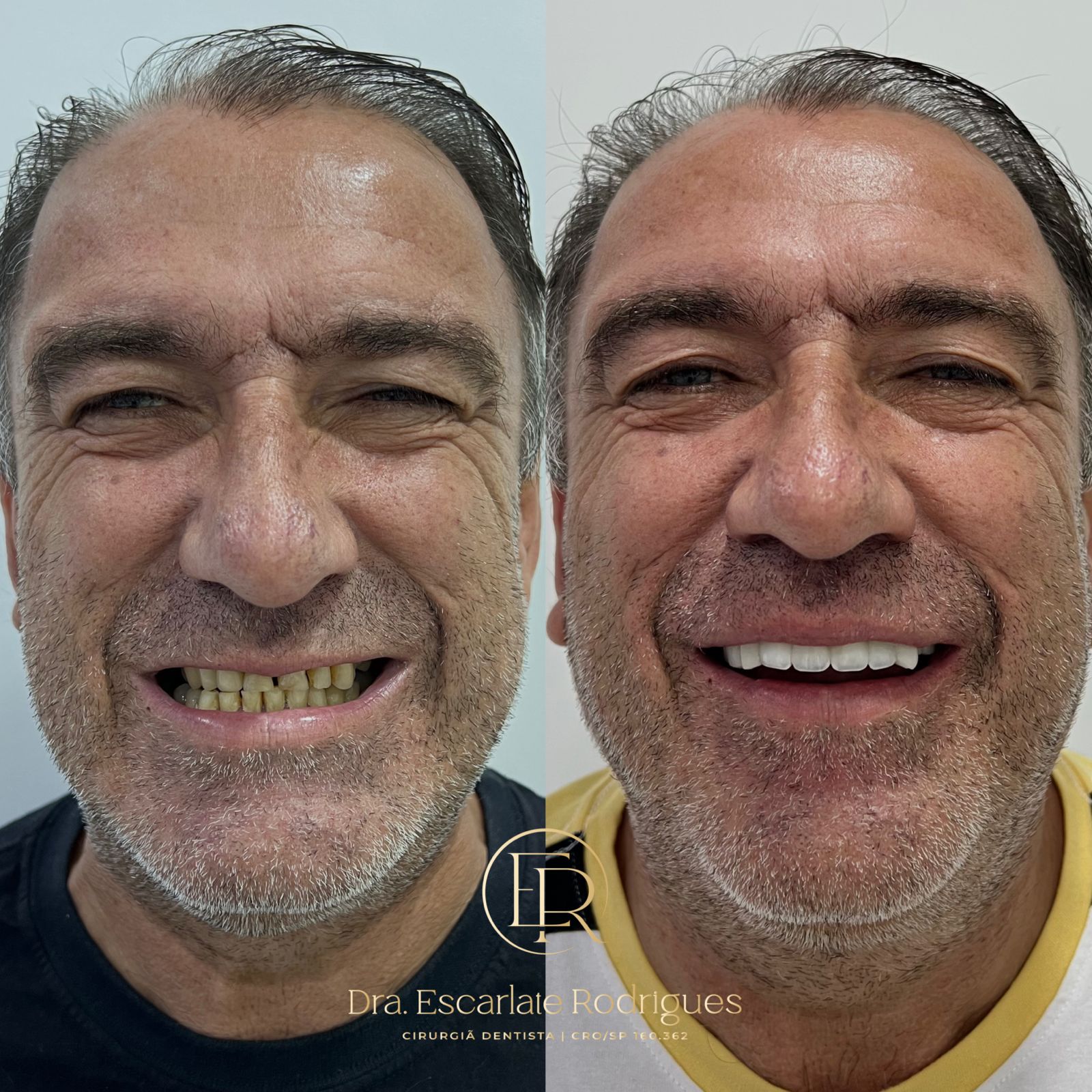 odonto-Antes-e-depois-resinas-4
